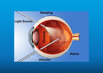 جراحی جداشدگی شبکیه