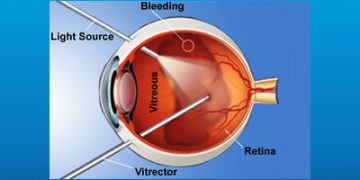جراحی جداشدگی شبکیه