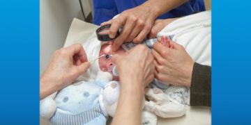 رتینوپاتی نوزادان نارس