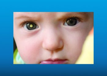 تومور رتینوبلاستوم در کودکان