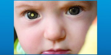 تومور رتینوبلاستوم در کودکان